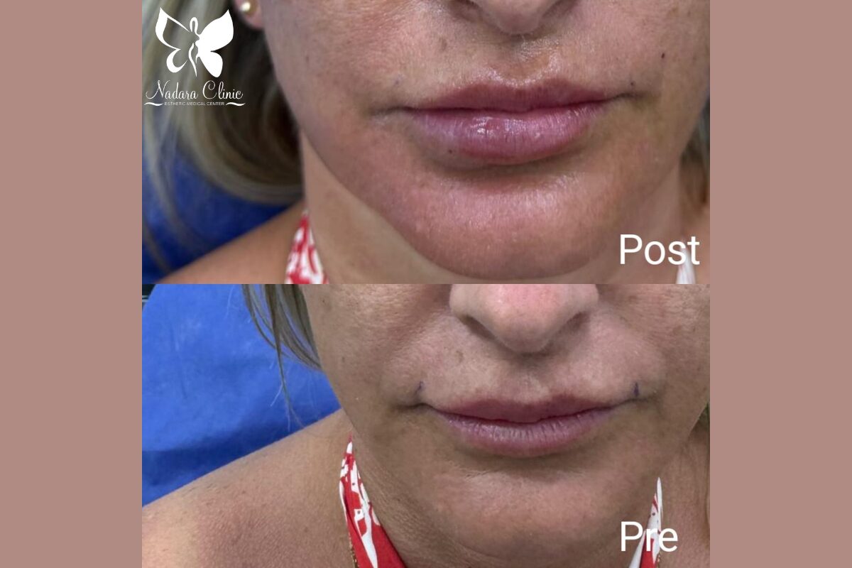 حقن الهيالورون فيلر في الغردقة